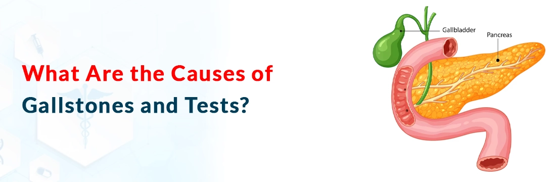 What Are the Causes of Gallstones and Tests?